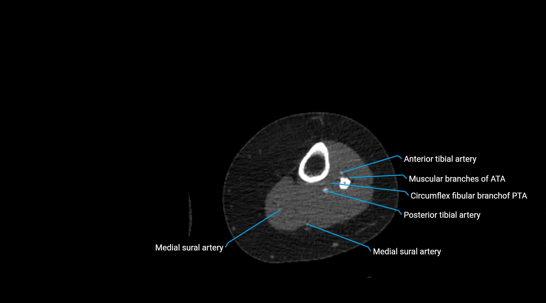 CTA lower limb cross sectional anatomy labelled image _196.webp